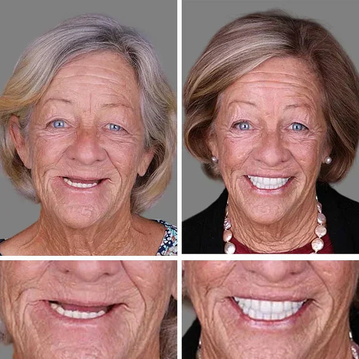 🎁🌎Ends Today: 48% OFF! ⏰KLENIMORE™ Medical Full Denture with Strong Suctiond🦷Obtain American Dental Association (ADA) Certification