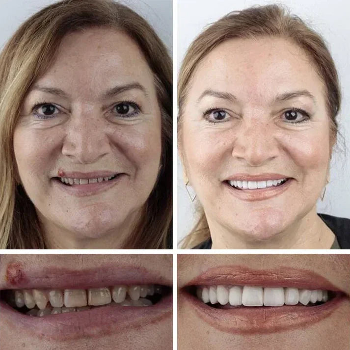 🎁🌎Ends Today: 48% OFF! ⏰KLENIMORE™ Medical Full Denture with Strong Suctiond🦷Obtain American Dental Association (ADA) Certification