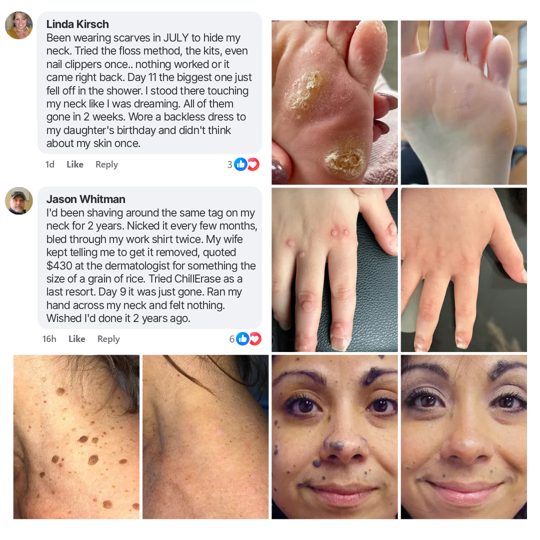 Chillerase Bump Renewal Spray: Safe, Fast Cryotherapy Wart Removal At Home