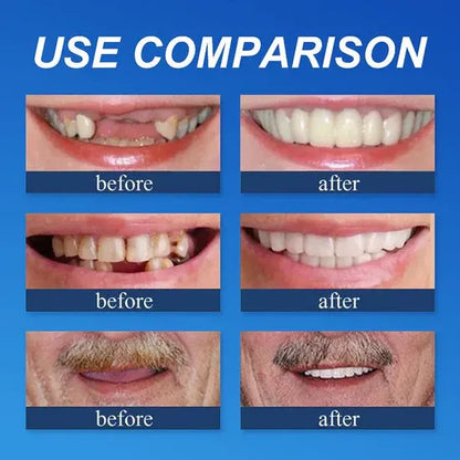 ⏰Ends Today: 40% OFF! 🌎KLENIMORE™ Custom-Fit  Dentures— Designed for Comfort and a Natural-Looking Smile