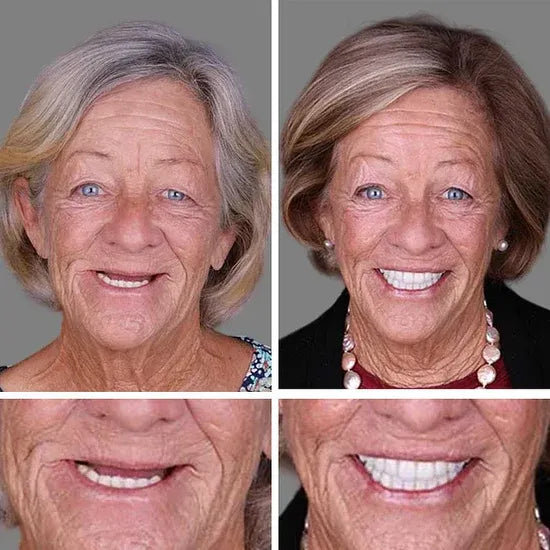 ⏰Ends Today: 40% OFF! 🌎KLENIMORE™ Custom-Fit  Dentures— Designed for Comfort and a Natural-Looking Smile