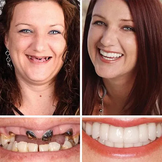 ⏰Ends Today: 40% OFF! 🌎KLENIMORE™ Custom-Fit  Dentures— Designed for Comfort and a Natural-Looking Smile