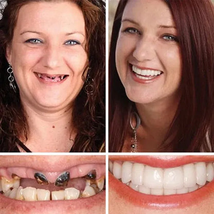 ⏰Ends Today: 40% OFF! 🌎KLENIMORE™ Custom-Fit  Dentures— Designed for Comfort and a Natural-Looking Smile